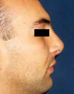 rhinoplastie apres chirurgie esthétique du nez en Tunisie