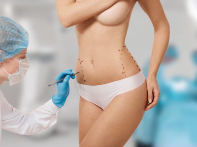 Chirurgie -abdominoplastie -Tunisie